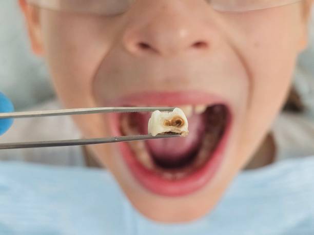 Best Emergency Treatment for Dental Infections or Abscesses in Tallmadge, OH